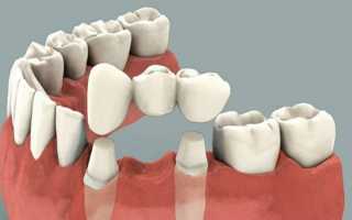 Особенности имплантации зубов и установки коронок