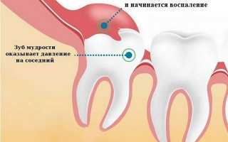 Рост зубов мудрости: боль в деснах