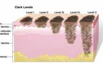 Прогноз и методы лечения меланомы в зависимости от ее стадии