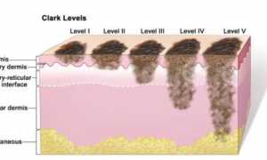 Прогноз и методы лечения меланомы в зависимости от ее стадии