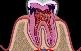 Как снять боль при воспалении зубного нерва