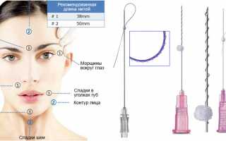 Как устанавливаются нити для подтяжки лица? Показания и противопоказания